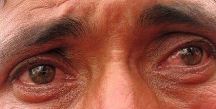 oczy osoby chorej na ślepotę śnieżną